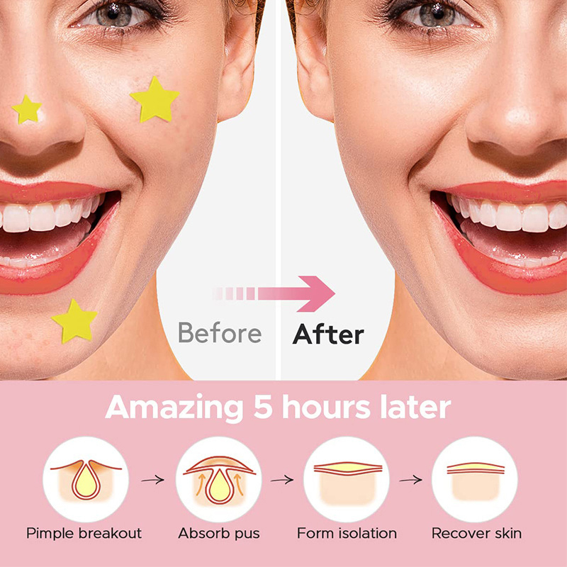 600 Piezas/Set Parches de Estr - Skincare Acne reseña y precio